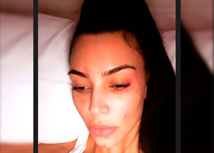 Kim Kardashian padece de Psoriasis matutina 