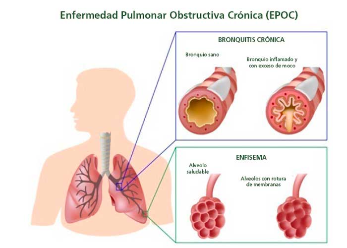 pulmones, epoc, salud, afectaciones, enfisema, bronquitis cronica, cigarrillos