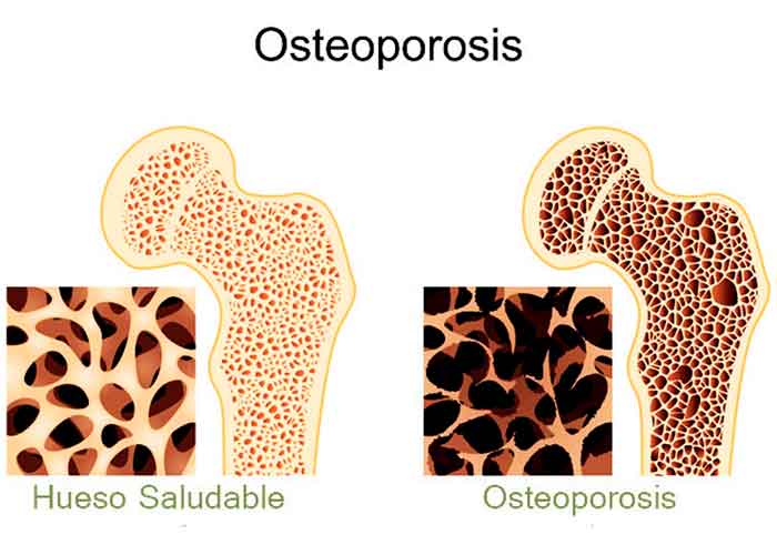 osteoporosis, salud, dia mundial, 20 de octubre, sintomas, causas, afectados, huesos