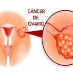 cancer de ovarios