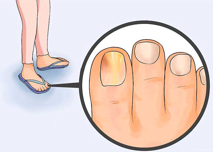 Consejos de salud Tratamiento de los hongos en las uñas de los pies  Red  de noticias de Mayo Clinic