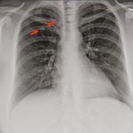 nodulos pulmonares
