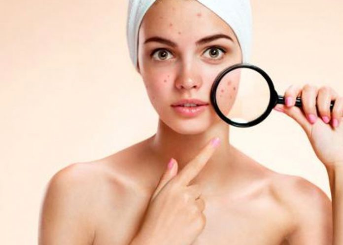 Foto: Consejos para tratar el acné según la zona afectada / Referencia