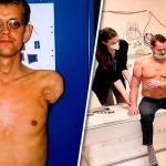 ¡Wow! Hombre que recibió primer trasplante de brazos ya puede mover sus bíceps