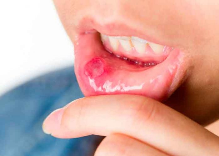 mucositis oral, riesgos, causas, efectos,
