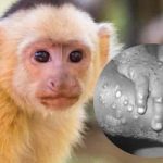 Identifican primer caso de viruela de mono en Texas, Estados Unidos