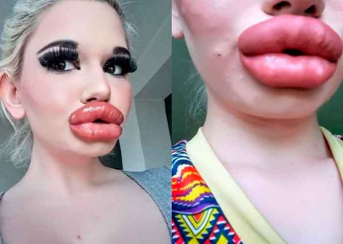 Mujer con los labios más grandes del mundo quiere parecerse a una Bratz