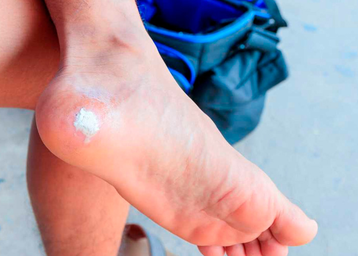  Científicos encuentran la cura para las úlceras del pie diabético