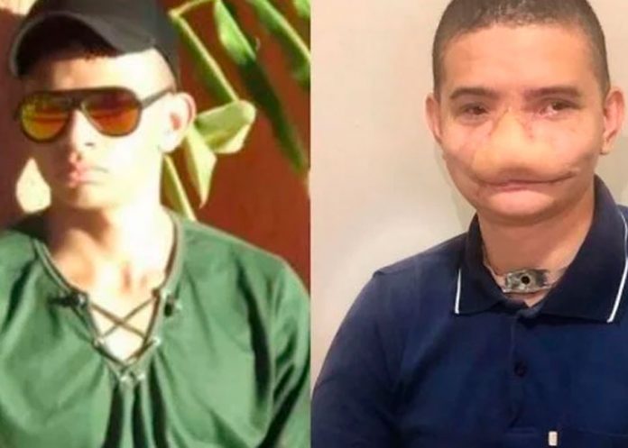 : La historia del joven de Brasil que tiene la cara desfigurada por la pirotecnia
