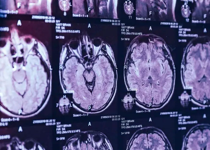 9 personas mueren a causa de misteriosa enfermedad neuronal en Canadá