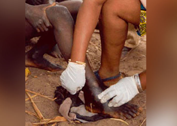 Ya van 14 casos en el mundo del "gusano de Guinea": ¿Qué es?