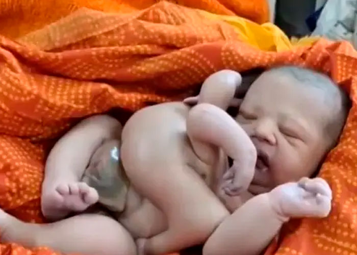 ¿Mal genético o reencarnación de Dios? nació un bebé con 8 extremidades en la India