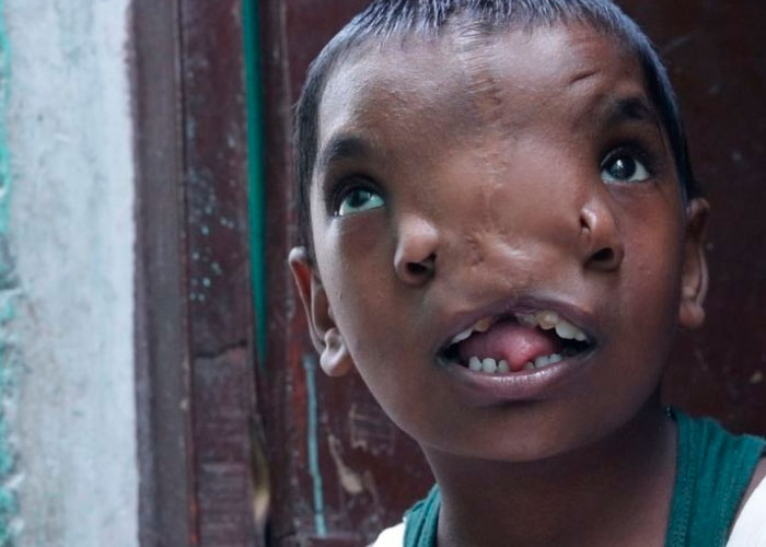 Inusual apariencia de una niña causa temor en la India 