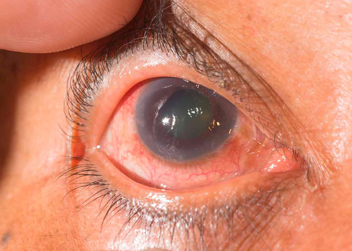 ¿Cómo podemos prevenir el glaucoma?, ¡Aquí te contamos!
