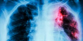 La OMS pide una inversión masiva para frenar la tuberculosis