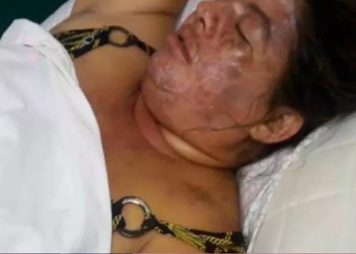 Argentina: Le arrojó agua hirviendo a su mujer porque se le cayó una cuchara