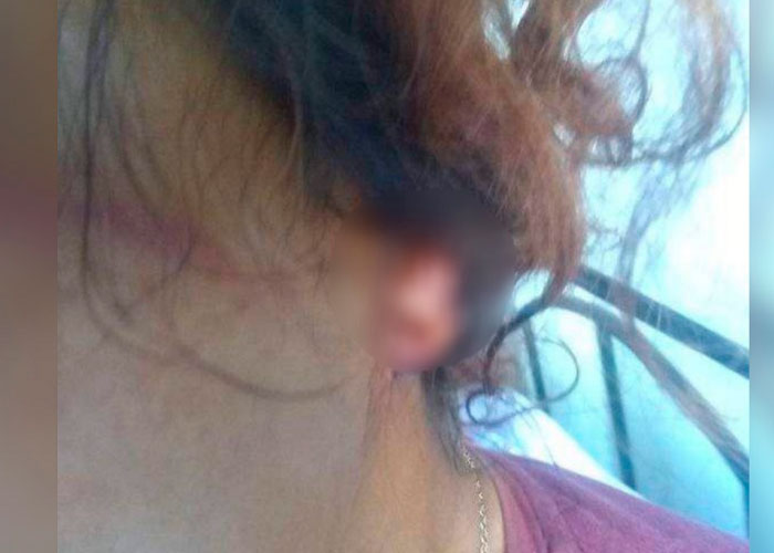 ¡Salvaje! De un mordisco le arrancó la oreja a su mujer en Colombia