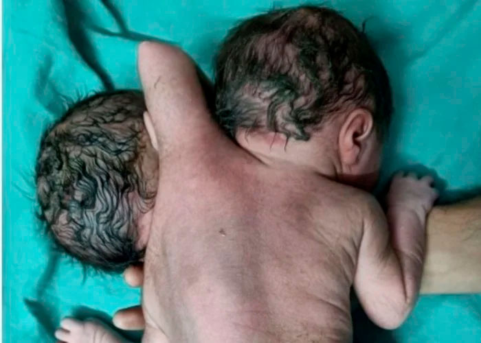 Bebé "milagroso" nació con dos cabezas, tres manos y dos corazones