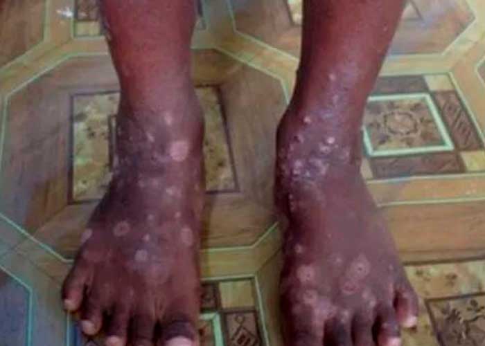 ¡Alerta sanitaria! Detectan una rara y contagiosa enfermedad en Haití