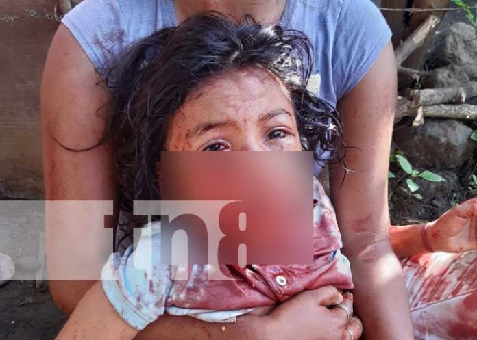 Pitbull ataca a una niña en Chichigalpa, Chinandega