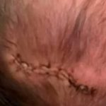 ¡Negligencia! Bebé recibió sutura en cabeza tras caer durante el parto