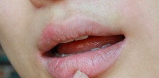 5 enfermedades que puedes detectar por "labios secos"