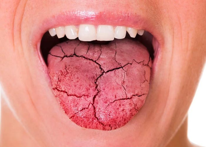 5 enfermedades que puedes detectar por "labios secos"