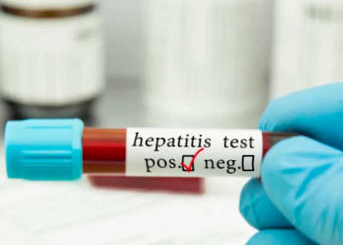 Emiten alerta epidemiológica por una misteriosa hepatitis en Perú