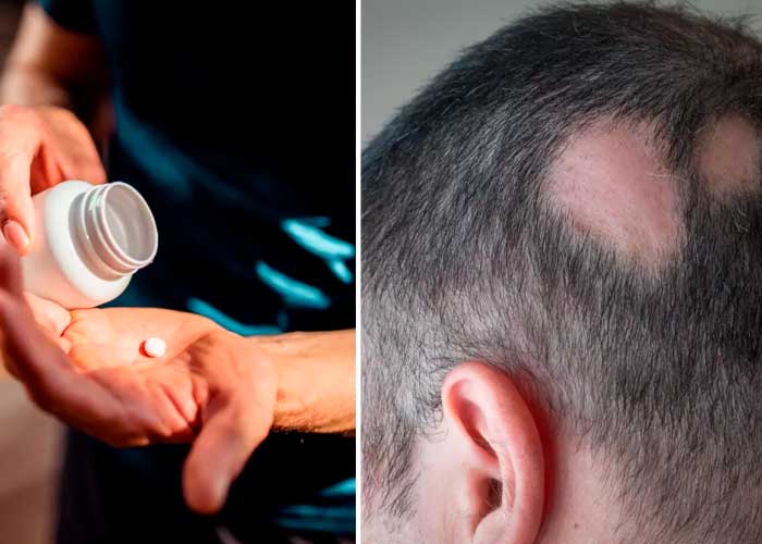 El fármaco para tratar la alopecia en menos de un año