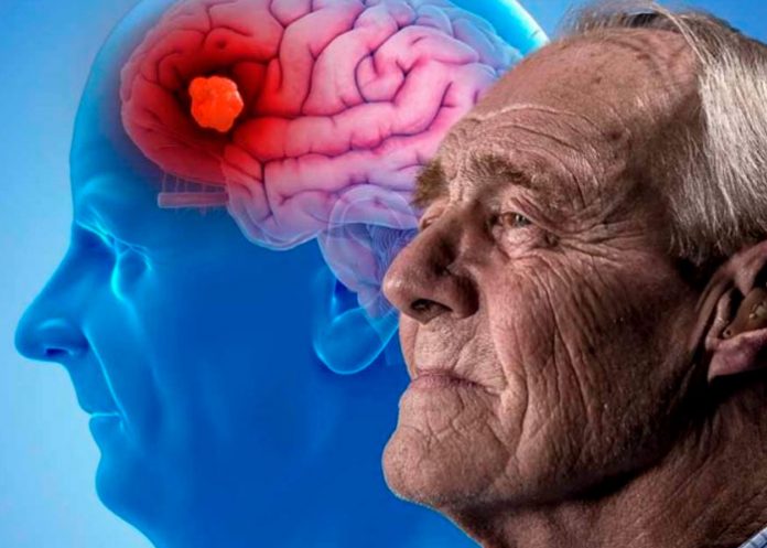 ¡Al fin! Alzheimer ya se puede detectar a tiempo con uso de escáner
