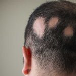 Un nuevo y prometedor medicamento contra la alopecia areata