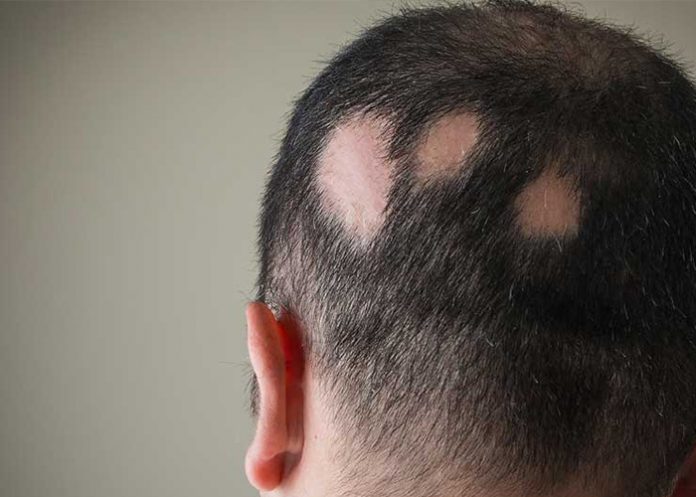 Un nuevo y prometedor medicamento contra la alopecia areata