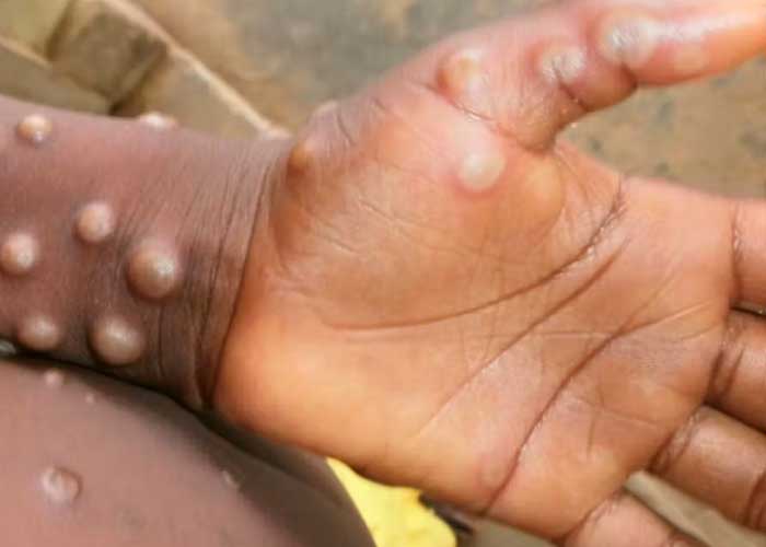 Entérate de otras enfermedades con síntomas similares a la viruela del mono