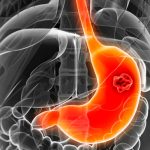 Síntomas y cómo prevenir el cáncer de estómago
