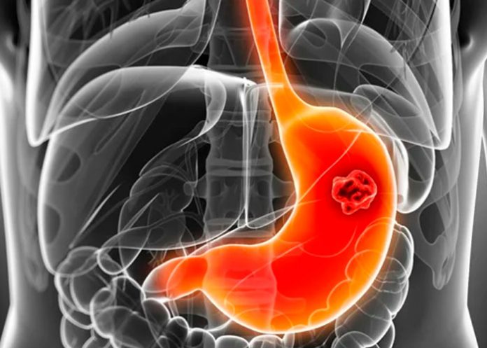 Síntomas y cómo prevenir el cáncer de estómago