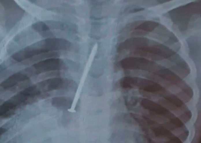 Un clavo en sus pulmones provoca la muerte de un niño en Brasil