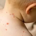"Gripe del tomate": La dolorosa enfermedad que afecta a niños