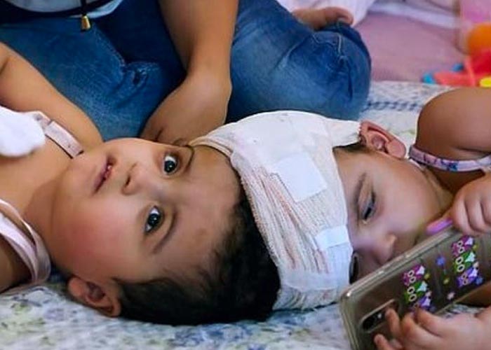 2 gemelos siameses en Brasil son sometidos a 7 cirugías