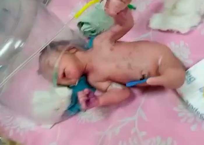 Insólito nacimiento de bebé con un cuerno en vez de piernas en la India