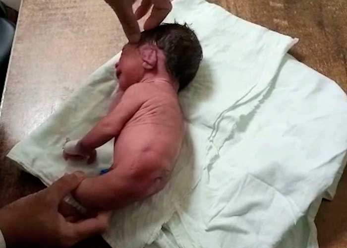 Insólito nacimiento de bebé con un cuerno en vez de piernas en la India