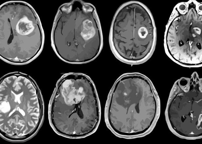 Neurocirujanos de Rusia extirparon un enorme tumor 