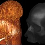 Neurocirujanos de Rusia extirparon un enorme tumor 