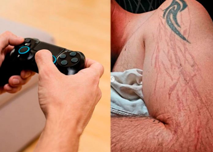 Joven es impactado por un rayo en su brazo mientras jugaba Playstation