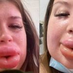 "La vanidad la envió al hospital": Mujer termina mal por inyectarse químicos
