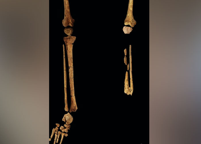 ¡Interesante! "La cirugía existe desde hace 31 mil años atrás"