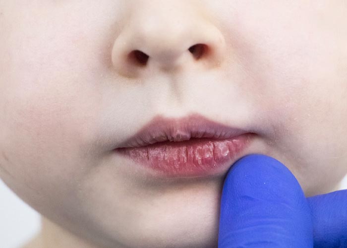 ¿Cómo podemos detectar la anemia en los niños?