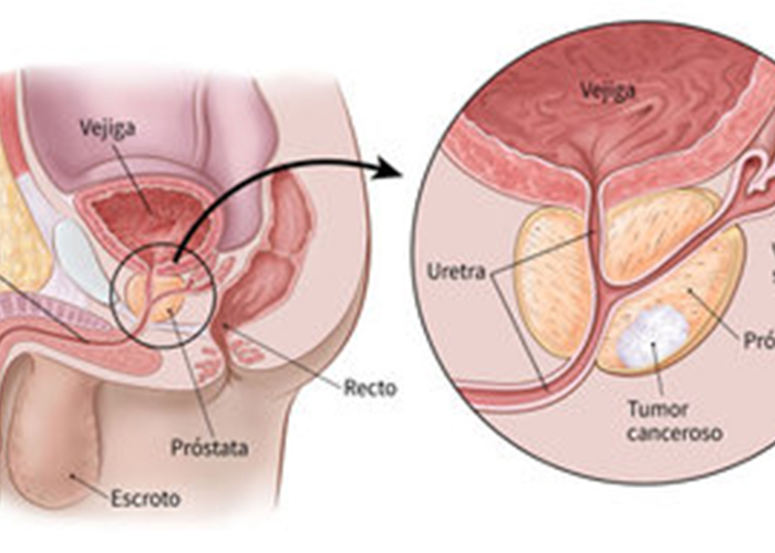 «Gen» regula la variación genética en el cáncer de próstata