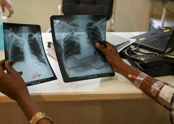 Un nuevo tratamiento corto y eficaz revoluciona la lucha contra la tuberculosis
