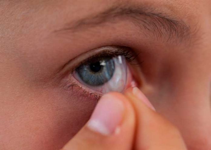 Tengan cuidado: Mujer acumuló 23 lentes de contacto en el ojo