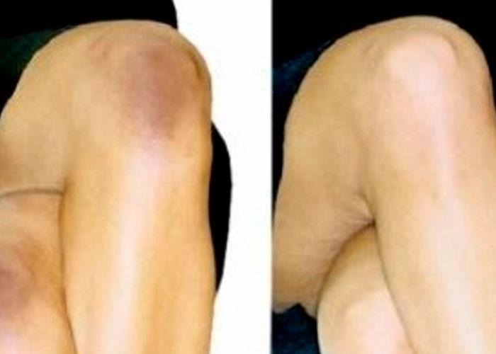 ¿Ya conocías estos tips para aclarar la piel de los codos y rodillas?